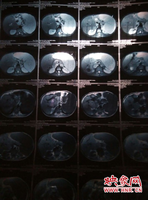 寧陵少年患病十幾年仍堅(jiān)持上學(xué) 無(wú)錢(qián)治病盼救助