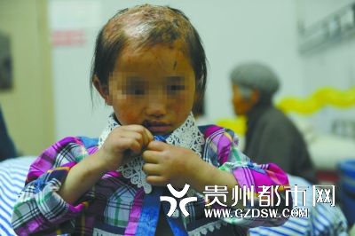 被燙傷的頭皮一直沒(méi)有愈合。