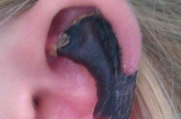 荷蘭女子旅游途中被蜘蛛咬，耳軟骨溶解變黑。