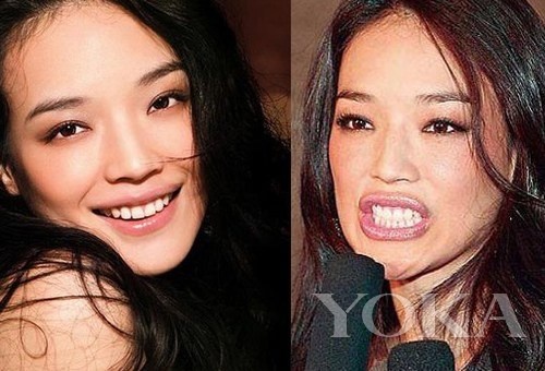 牙齒凸出，口輪肌過于松弛