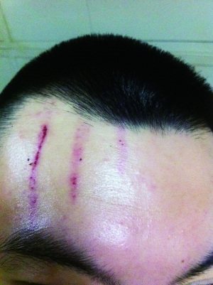 　2013年，被打者受傷照