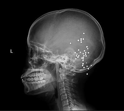 X射線(xiàn)顯示的子彈位置