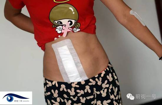 小金腹部的傷口。