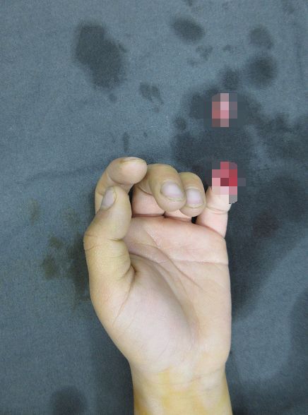 嚇哭！6歲男孩被夾斷手指 罪魁禍首竟是校服