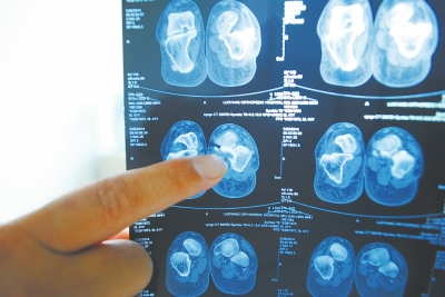 X光片顯示,確實(shí)有一根殘留的螺絲釘。