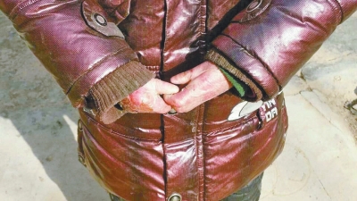 長期受損的手指，已經(jīng)長在了一起。