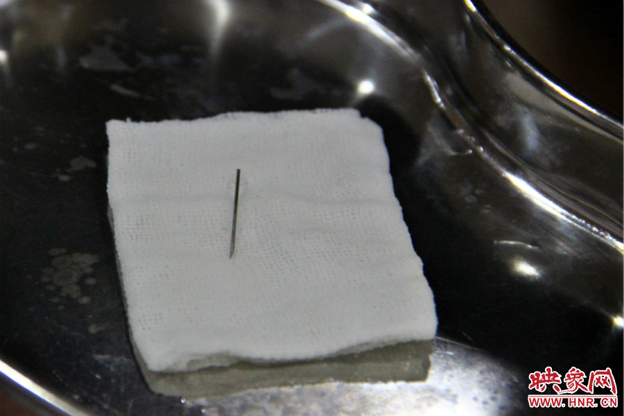 上午11點30分許，小龍腦中鋼針已經(jīng)成功取出。