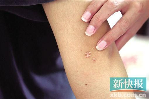 取出針后李星兒手臂留下了傷口。新快報記者 張國鋒/攝