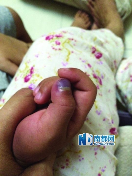 小逸手指被夾傷。