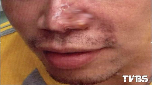 男生為追學妹整成“李敏鎬鼻”術(shù)后鼻翼潰爛（圖）
