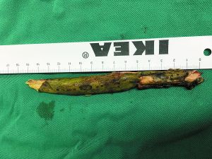 插入男子腦內(nèi)的樹枝。