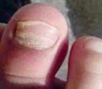 一幼兒園兒童“指甲異?！? title=